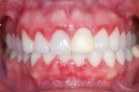 خونریزی لثه هنگام مسواک زدن نشانه چیست؟