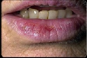 اصول مراقبت از لب ها در هوای سرد
