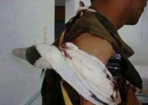 خمپاره‌‌ داعش در کتف رزمنده فرو رفت اما منفجر نشد + عکس