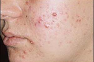 چگونه از چربی اضافه پوست خلاص شوید؟