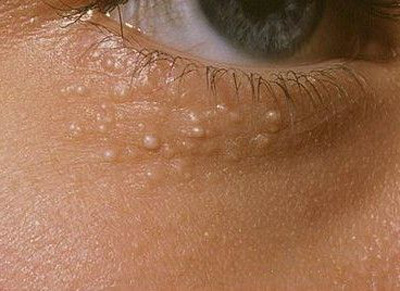 علت بروز و درمان دانه‌های چربی سفید رنگ زیر چشم