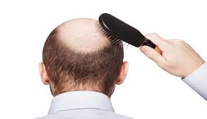 ریزش مو نشانه کدام بیماری است؟